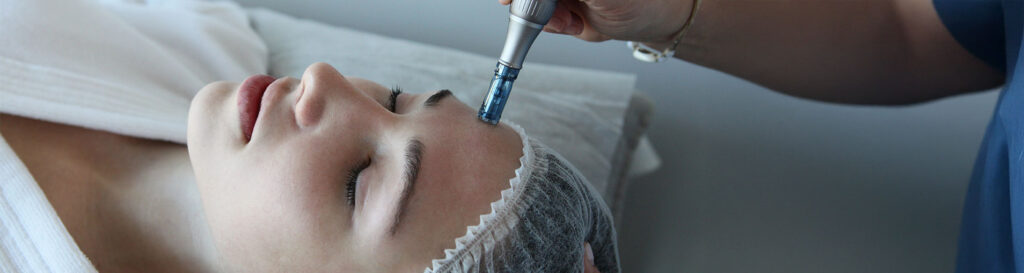 microneedling